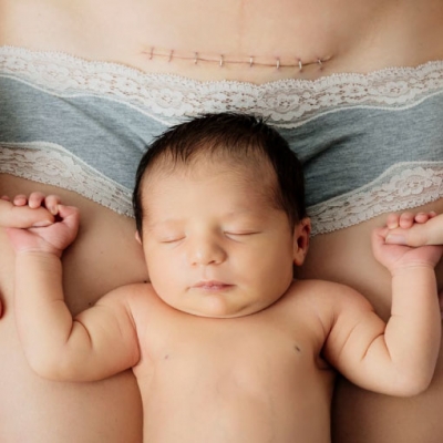Cicatrici della nascita |  Blog - Donatella Musarò Ostetrica